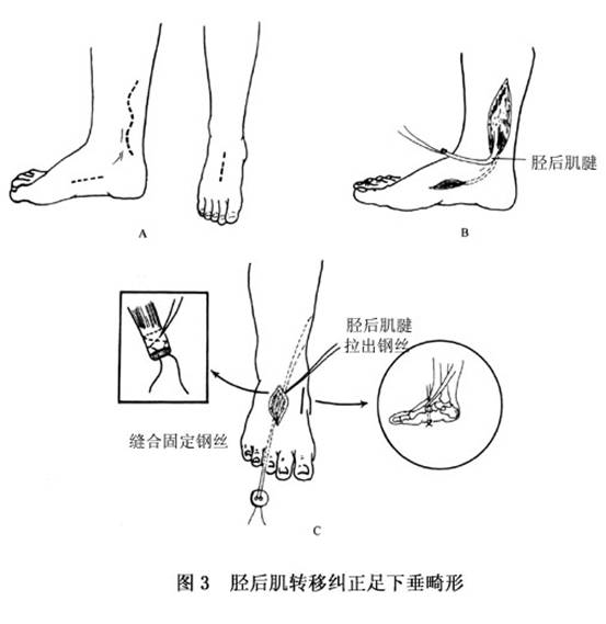 腓总神经损伤