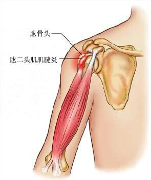 肌腱损伤