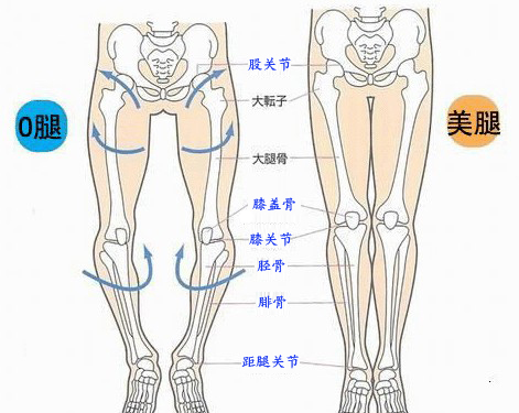 膝内翻,你不知道的危害!
