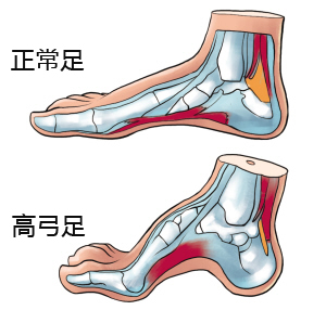 高弓足的治疗费用