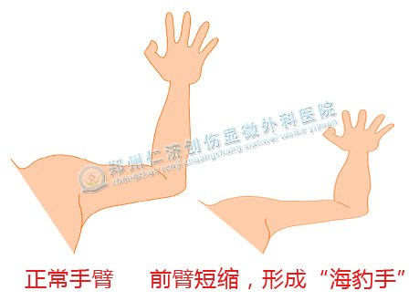 海豹手什么时候手术
